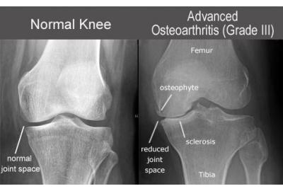 Types of Knee Braces for Arthritis