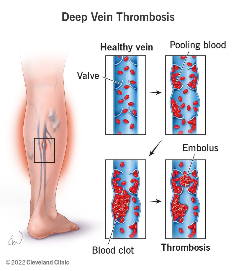 Tynor DVT Stocking Knee High Pair to manage deep vein thrombosis by  effective graduated compression 