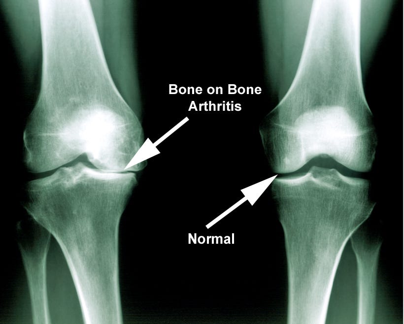 Knee Supports for Bone-On-Bone Knee Pain 