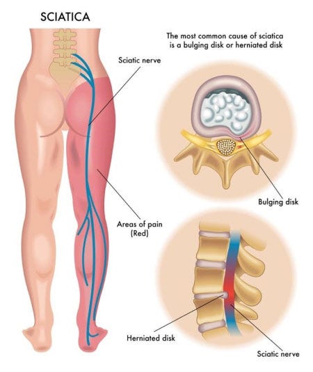 Best Back Braces for Sciatica and Piriformis Syndrome - OrthoMed