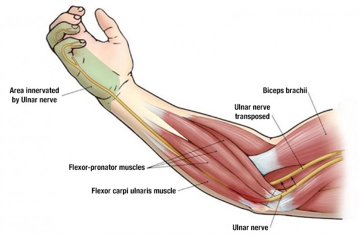 Ulnar Nerve Injuries  Hand2Shoulder Clinic