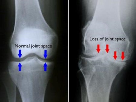  BraceAbility Osteoarthritis Unloader Knee Brace - Best  Tricompartmental OA Support for Bone on Bone Arthritis Pain, Medial or  Lateral Compartment Valgus Unloading, Arthritic Cartilage Repair (Right) :  Health & Household