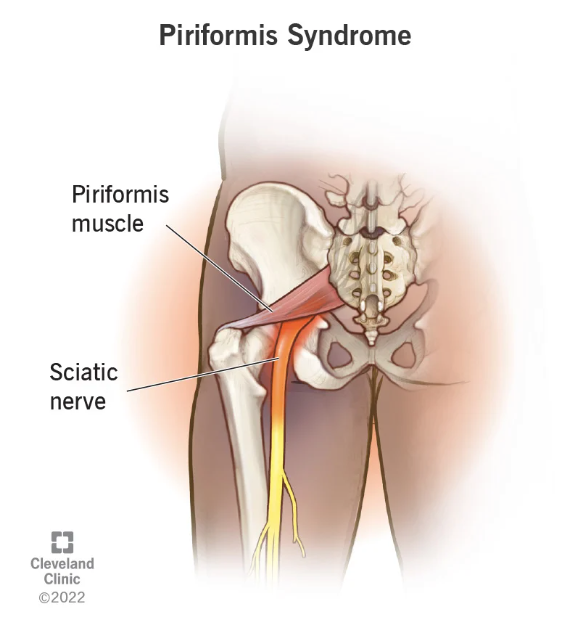 What Is Piriformis Syndrome? - MASS4D® Foot Orthotics