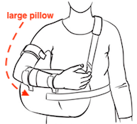 What's The Best Shoulder & Arm Sling, Immobilizer, or Stabilizer